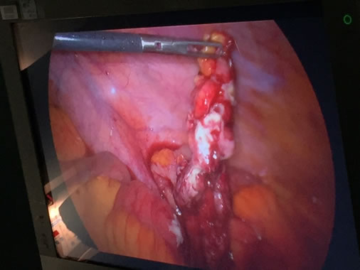 dolore appendicite peritonite
