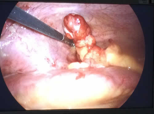 Appendicite acuta con gangrena e ascesso