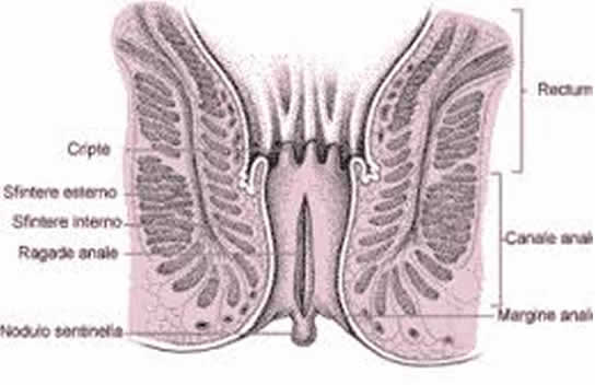 sesso anale e cancro rettale
