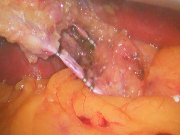 colecistectomia dotto e arteria cistica legati