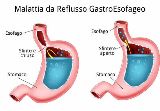 malattia da reflusso gastro esofageo